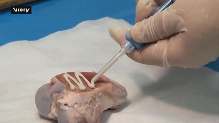 Trung Quốc phát minh keo gắn xương đầu tiên trên thế giới